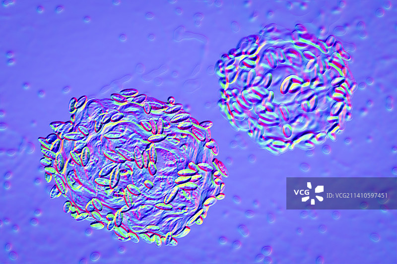 细菌性阴道病，图示图片素材