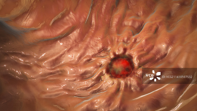 胃溃疡插图图片素材