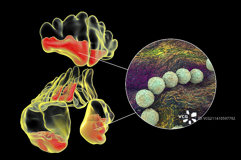 鼻窦炎插图图片素材