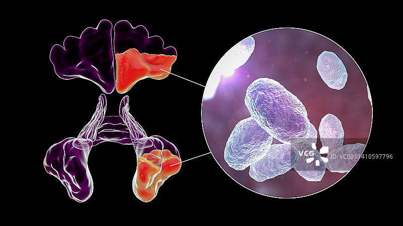 鼻窦炎插图图片素材
