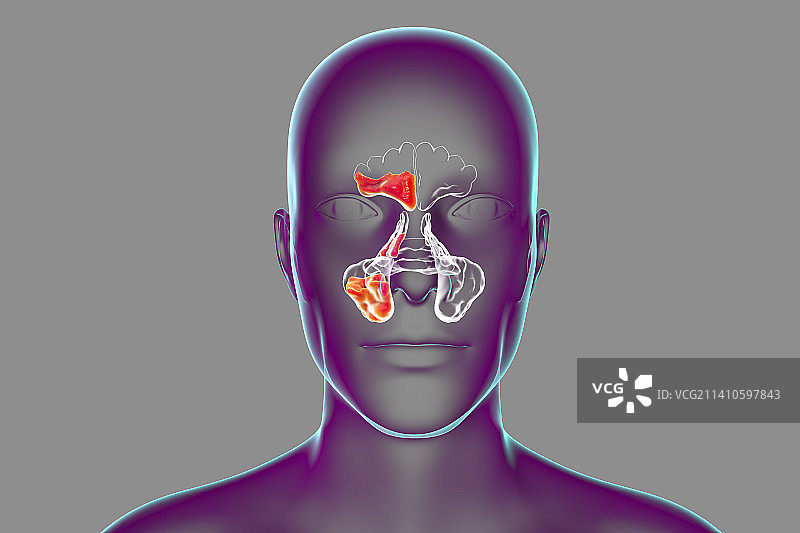 鼻窦炎插图图片素材