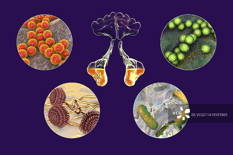 鼻窦炎插图图片素材