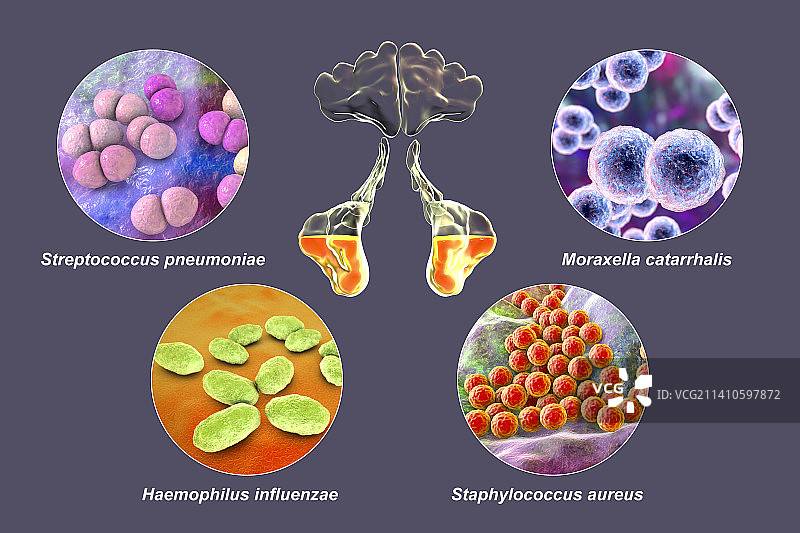 鼻窦炎插图图片素材