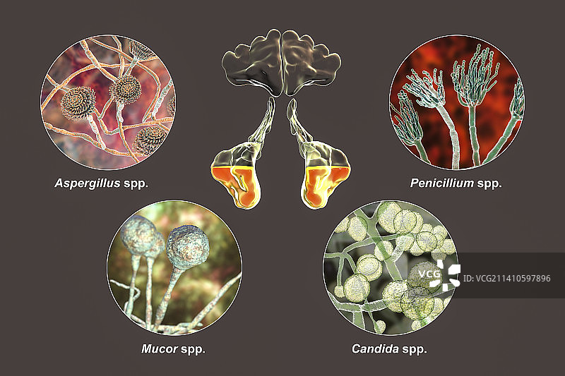 鼻窦炎插图图片素材