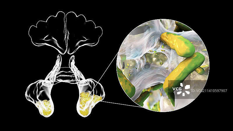 鼻窦炎插图图片素材