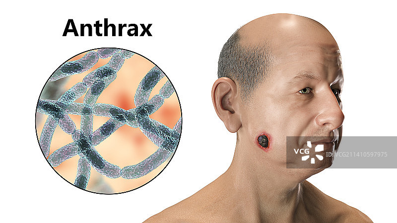 皮肤炭疽病插图图片素材