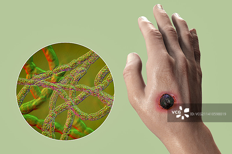 皮肤炭疽热，插图，仅做科普示意。图片素材