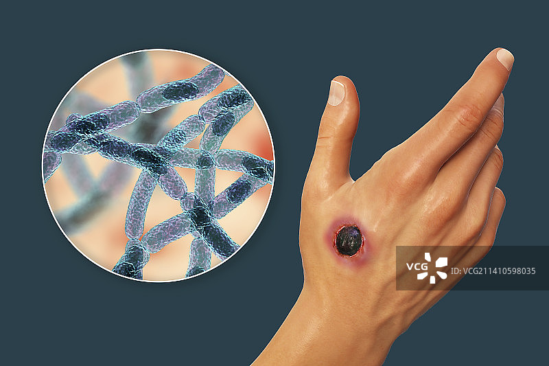 皮肤炭疽热，插图，仅做科普示意。图片素材