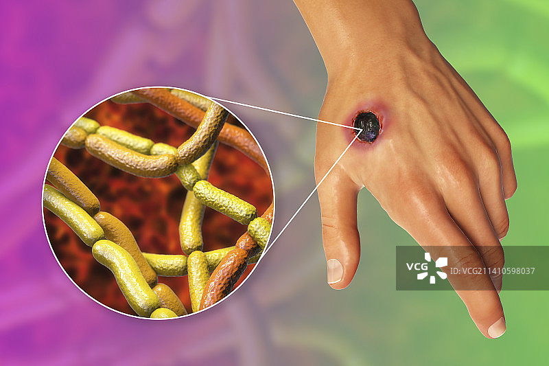 皮肤炭疽病插图图片素材