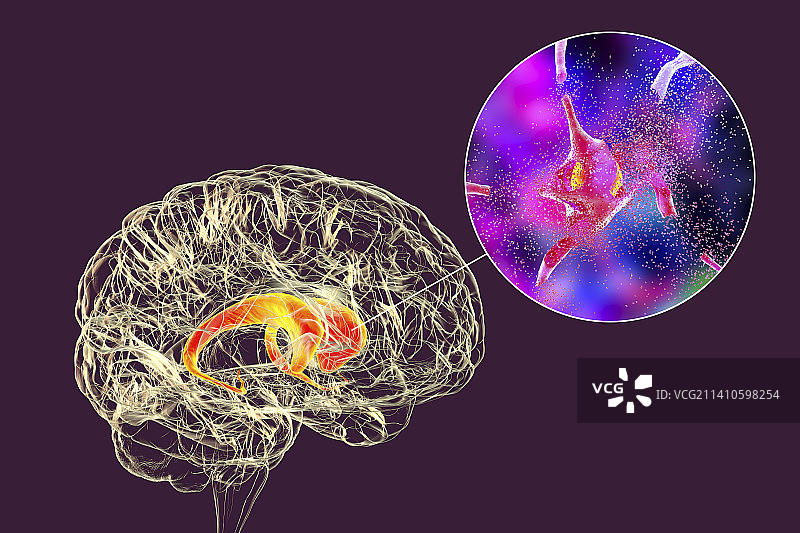 尾状核神经元破坏示意图图片素材