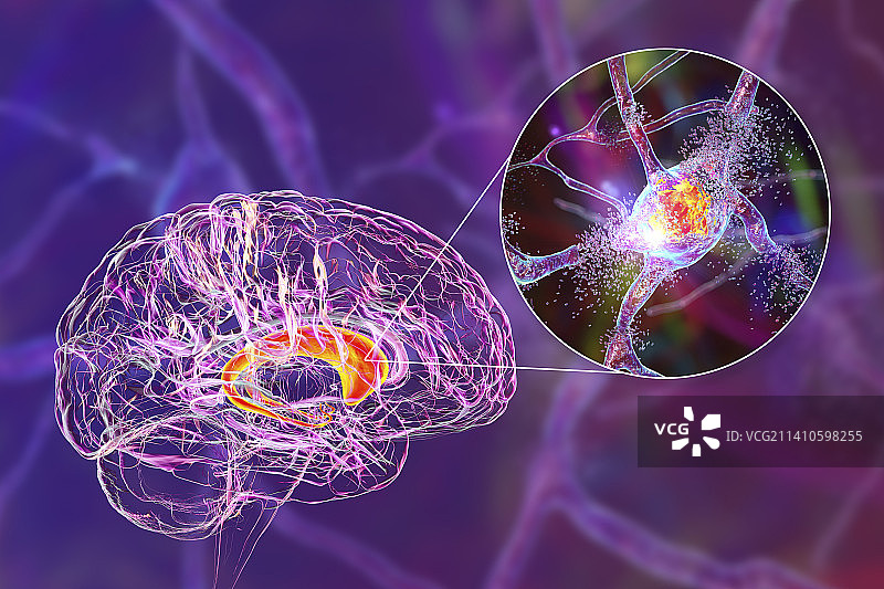 尾状核神经元破坏示意图图片素材