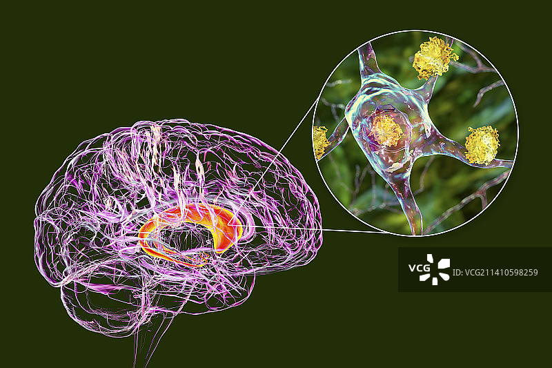 亨廷顿舞蹈病中的神经元内含物，图示图片素材
