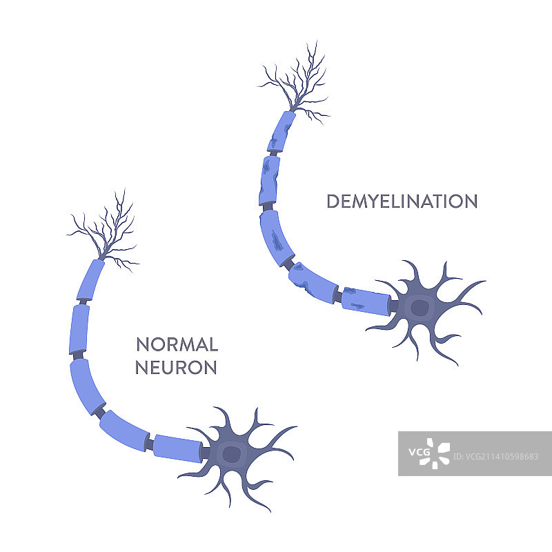 脱髓鞘疾病，图示图片素材