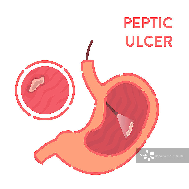 消化性溃疡诊断的概念图图片素材