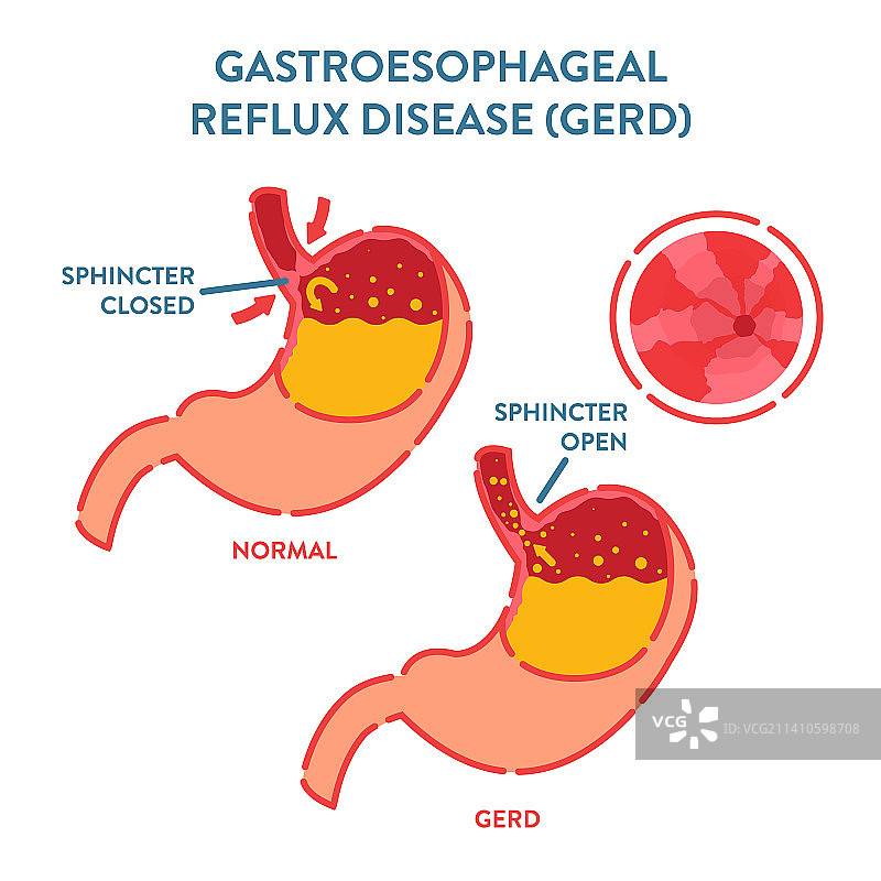 胃食管反流疾病图示图片素材