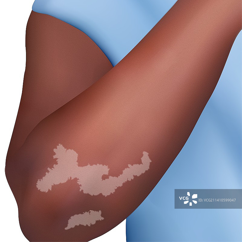 白癜风插图图片素材