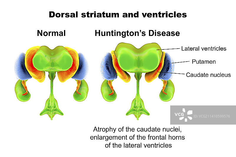 亨廷顿舞蹈病中的背侧纹状体和脑室图片素材