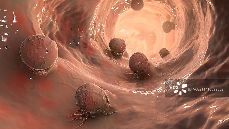 结直肠息肉，图示图片素材