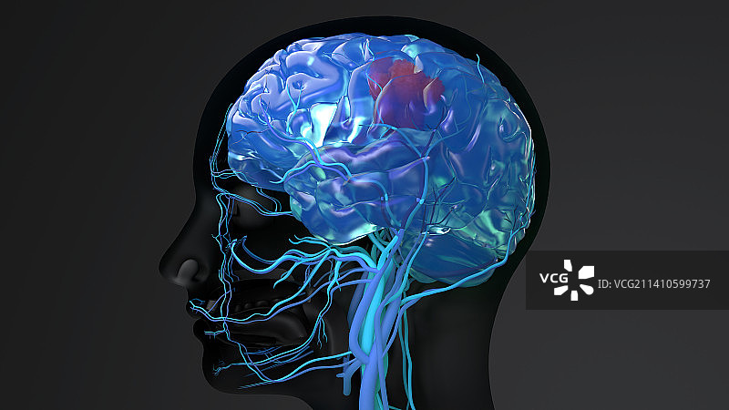 脑癌概念图图片素材