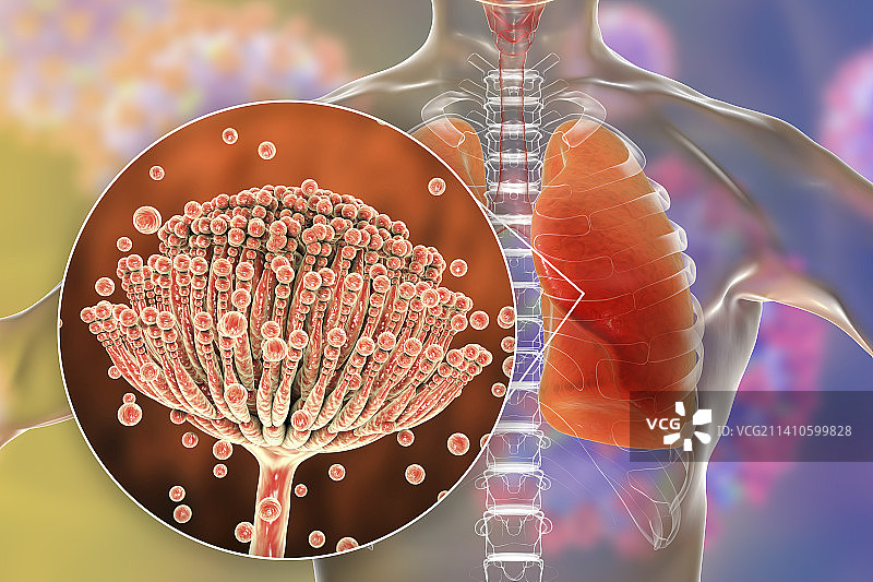 肺曲霉菌病插画图片素材