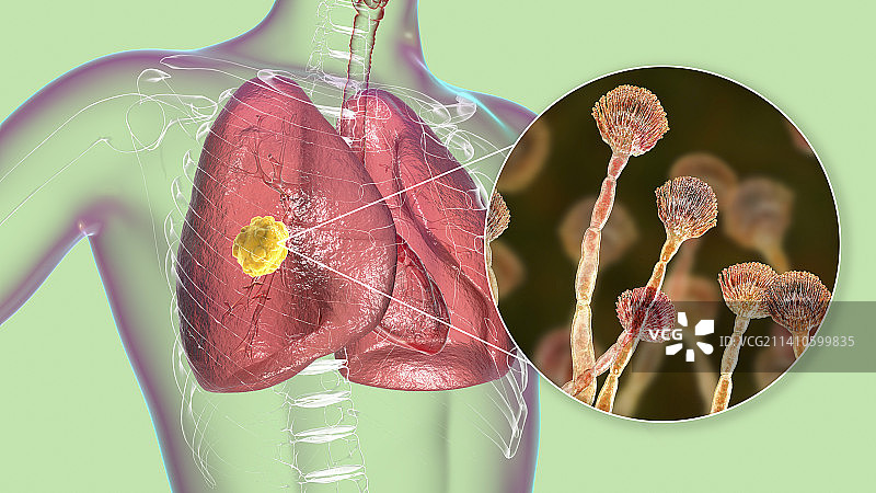 肺曲霉菌病插画图片素材