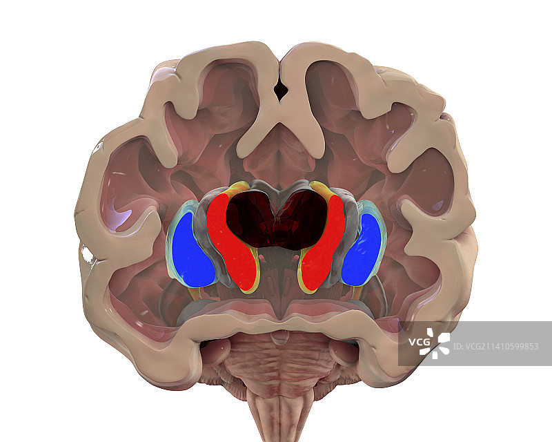 亨廷顿舞蹈症中的背侧纹状体，图示图片素材