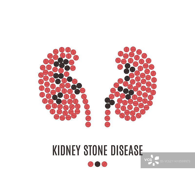 肾结石疾病概念图图片素材
