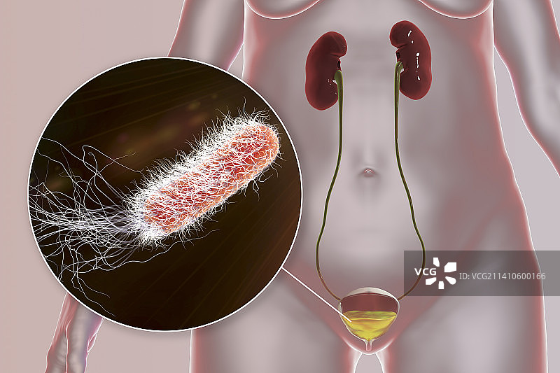 细菌性膀胱炎插图图片素材