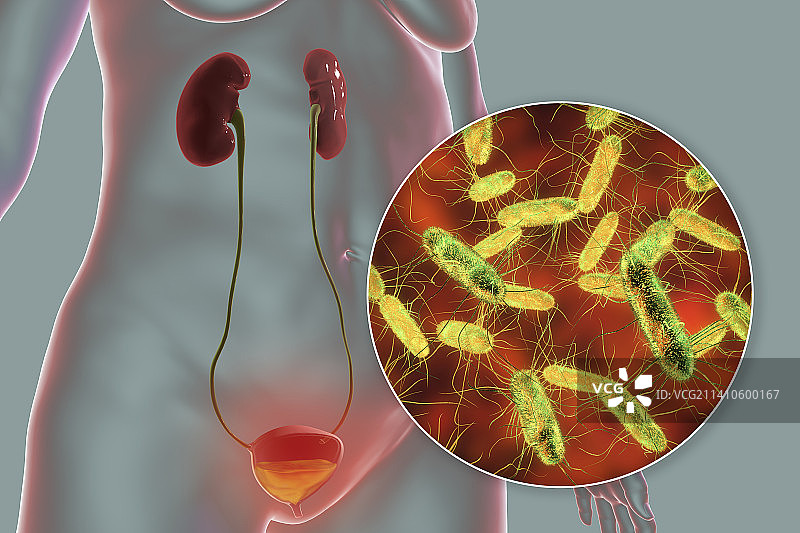细菌性膀胱炎插图图片素材