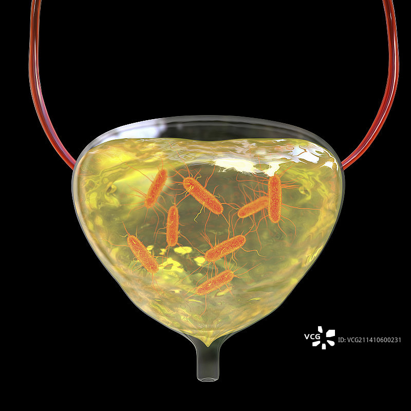 细菌性膀胱炎插图图片素材