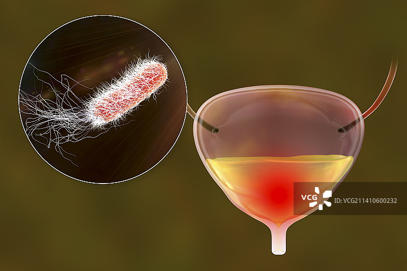 细菌性膀胱炎插图图片素材