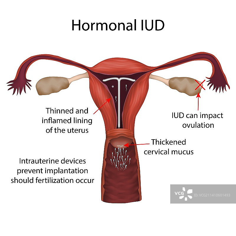 含激素宫内节育器插图图片素材