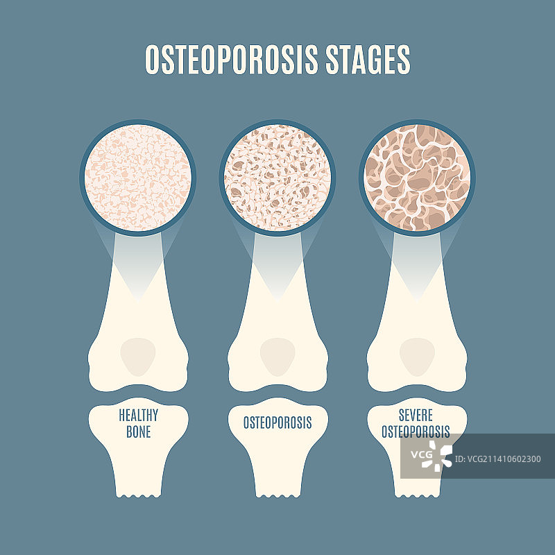 骨质疏松症概念图图片素材