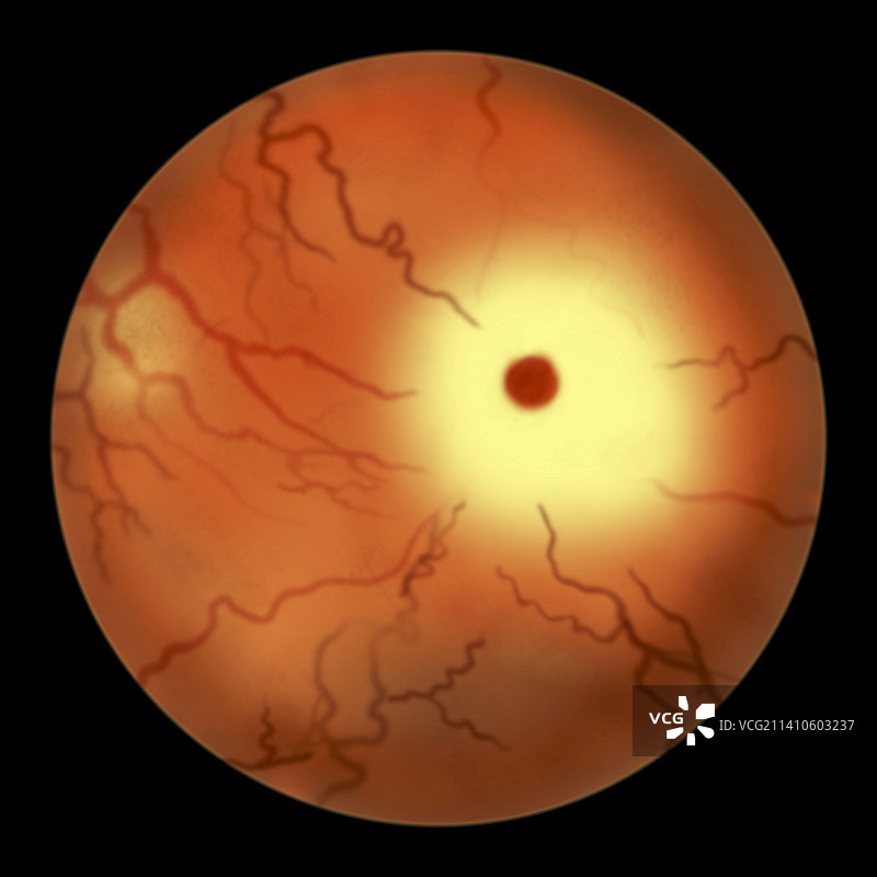 Tay-Sachs病中的视网膜图图片素材