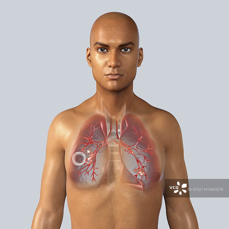 空洞型肺结核插画图片素材