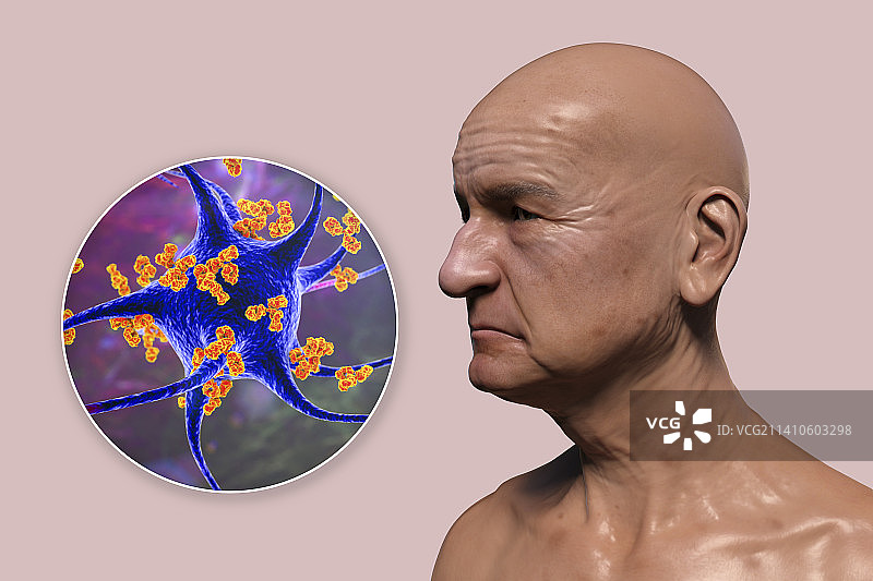 神经退行性疾病中的抗体，图示图片素材