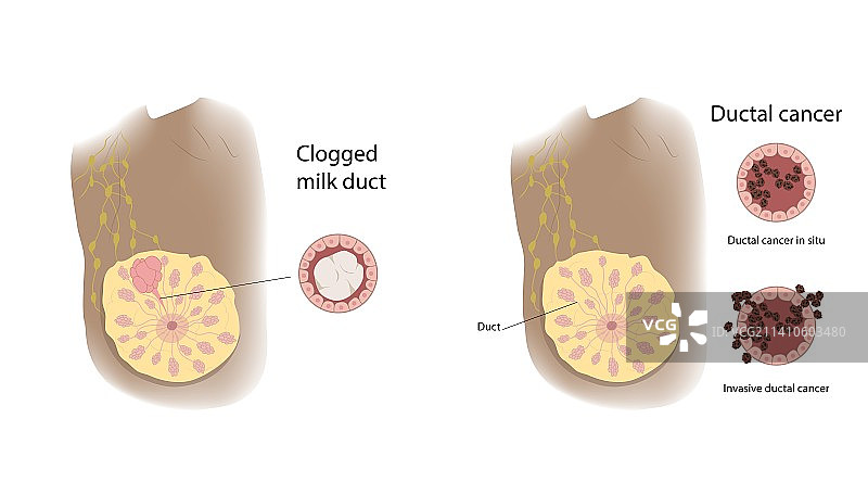 乳腺导管堵塞与导管癌对比图图片素材