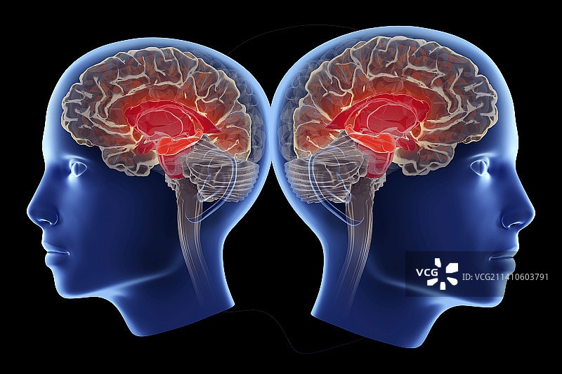 影响海马体的阿尔茨海默病图示图片素材