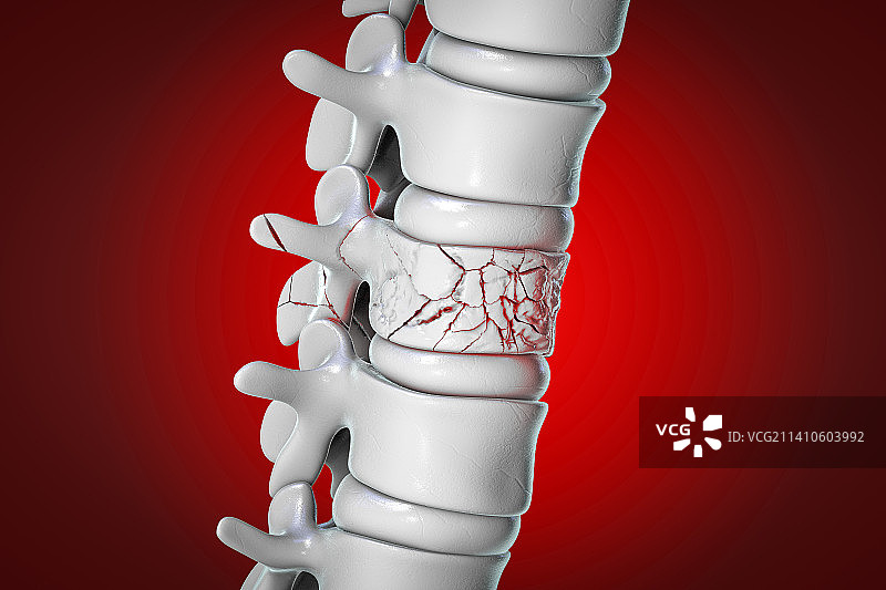 脊椎骨折插图图片素材