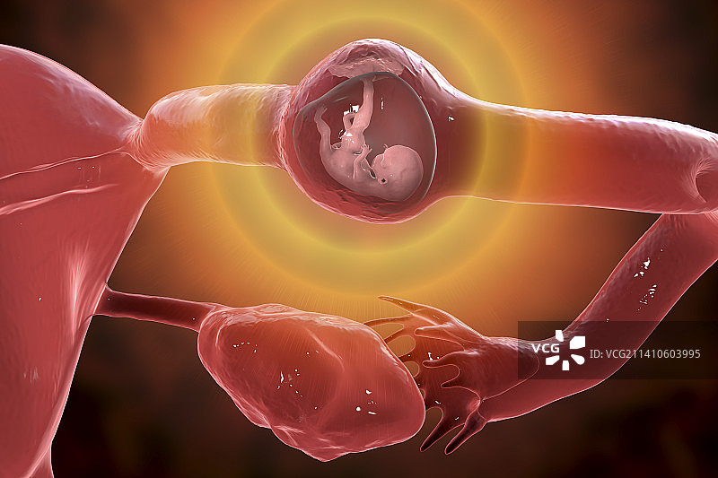 异位妊娠插图图片素材