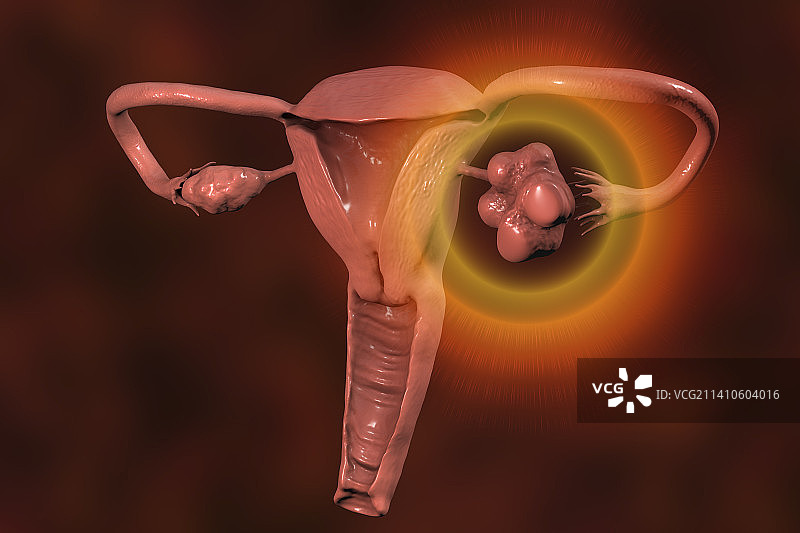 多囊卵巢综合征插图图片素材