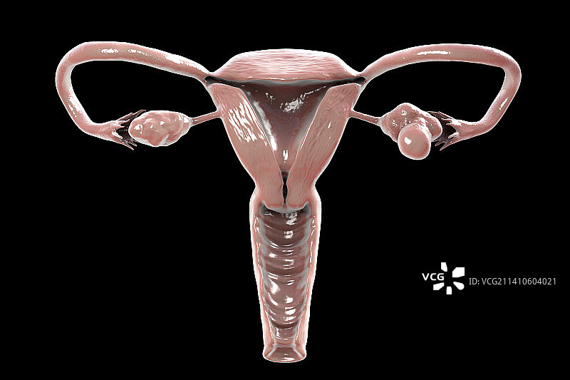 多囊卵巢综合征插图图片素材