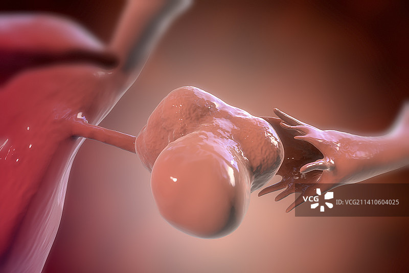 多囊卵巢综合征插图图片素材