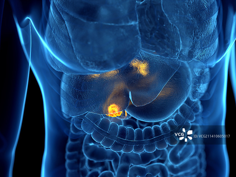 胆囊癌插画图片素材