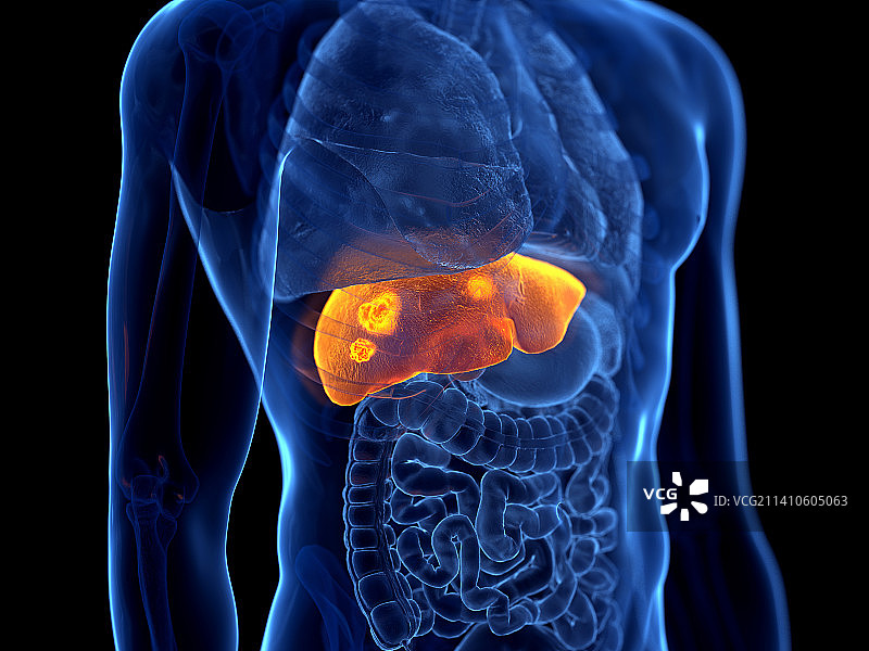肝癌，图示图片素材