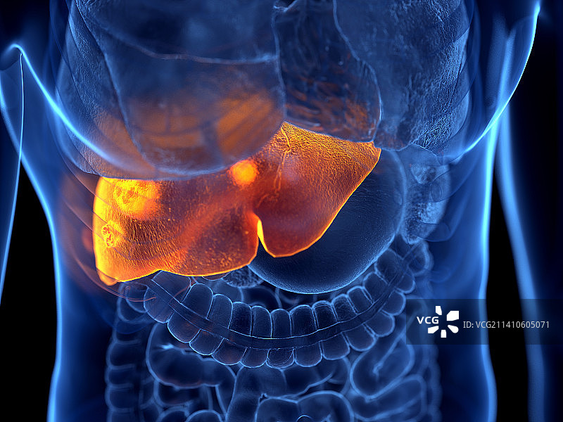 肝癌，图示图片素材