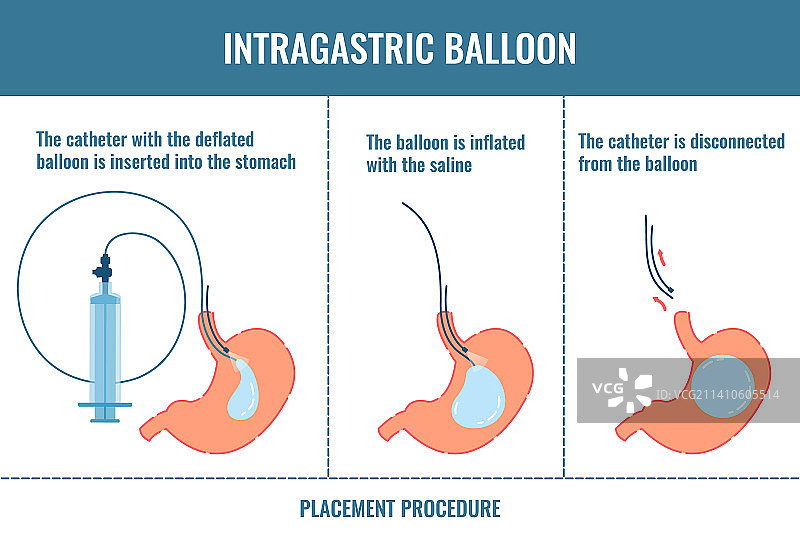胃球囊概念图图片素材
