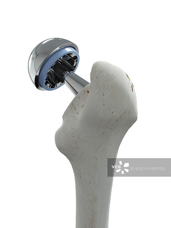 髋关节置换术插图图片素材