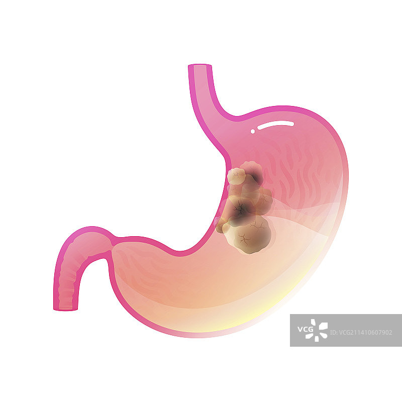 胃癌插图图片素材