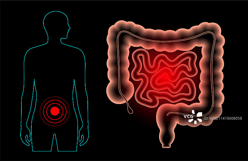 肠道疾病插图图片素材